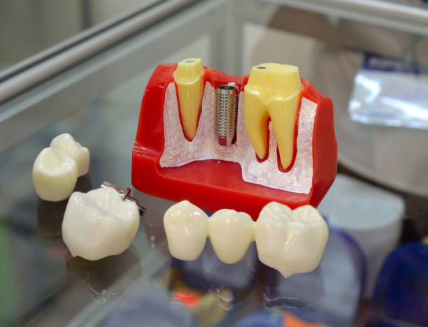 زراعة الأسنان