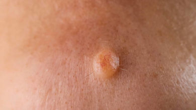 الورم الليفي