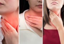 حرقة البلعوم